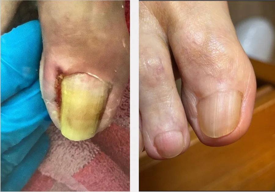 Entzündeter Nagelrand bei Nagelpilz vor und nach der Behandlung